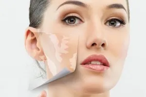 SURYANSH VITILIGO SKIN CARE CENTER