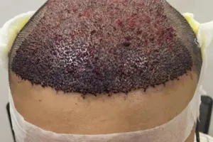 Rebind Hair Transplant Clinic Kolhapur - Best Hair Transplant in Kolhapur