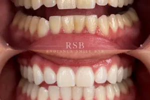 Radiance Smile Bar